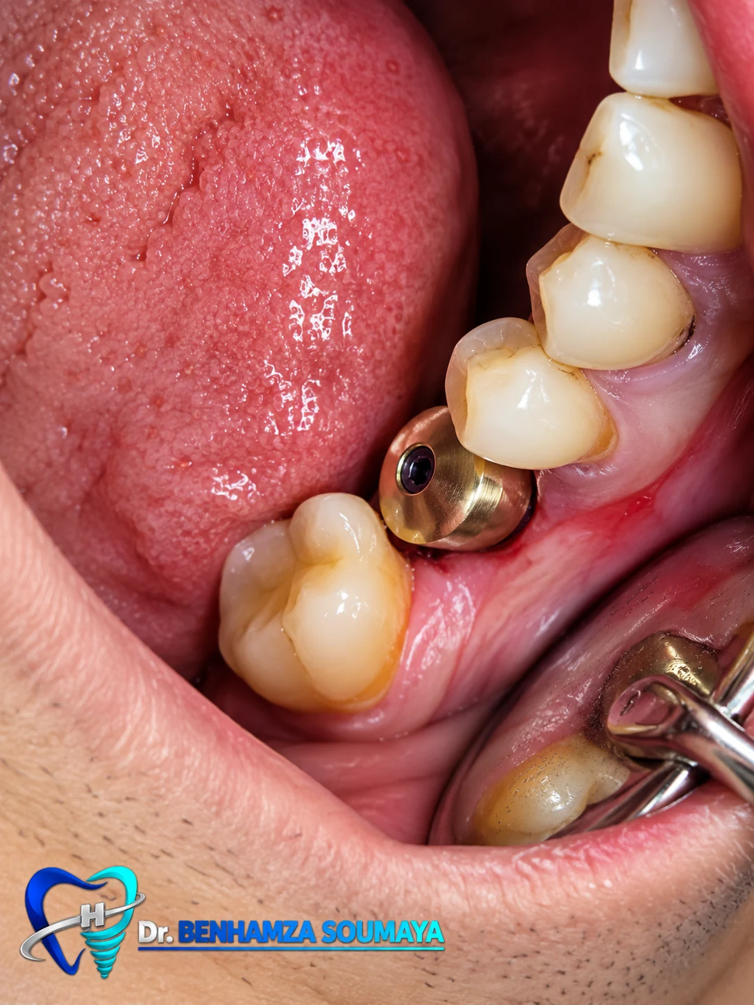 Vue intra-orale d’un implant dentaire au Smile’s Centre
