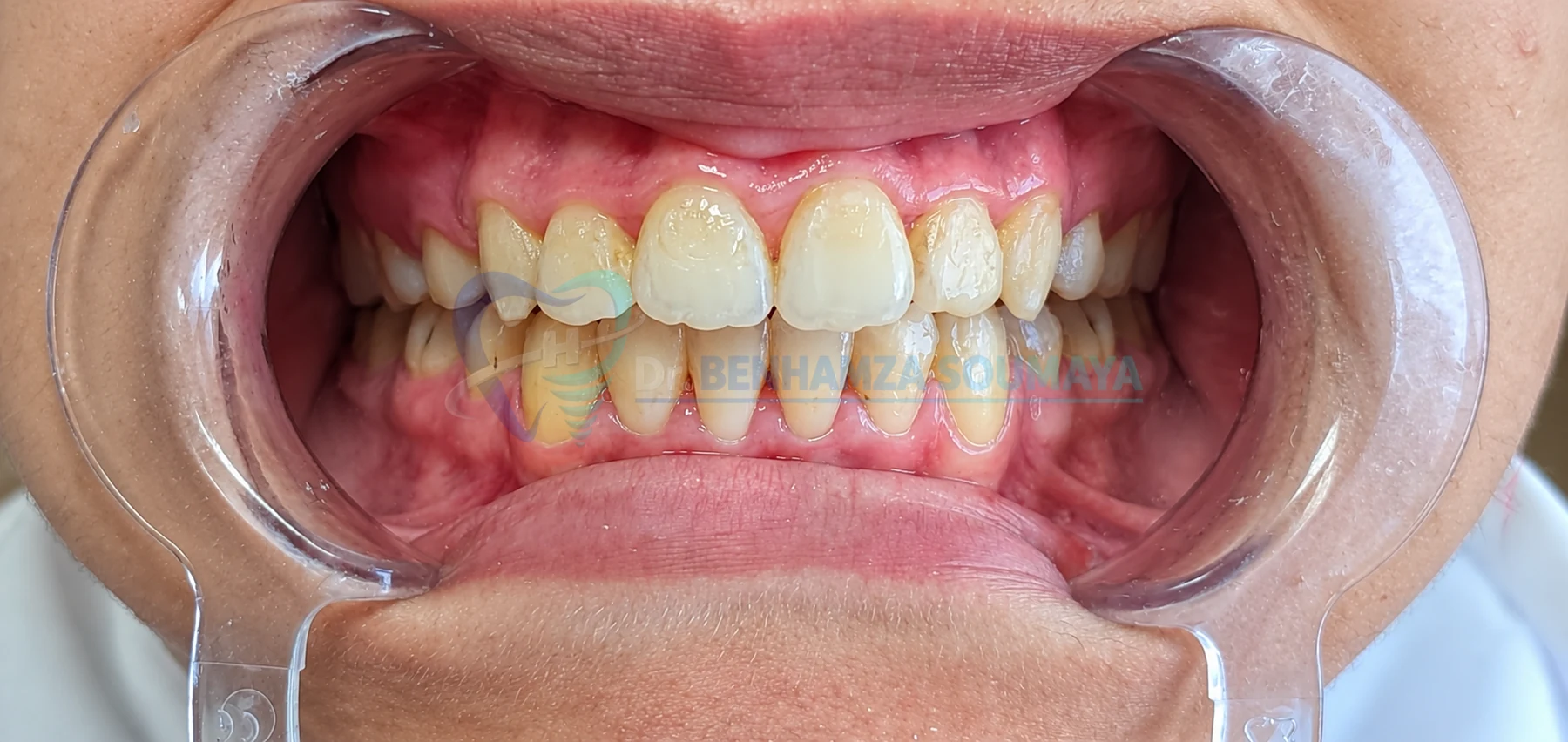 Orthodontie avant
