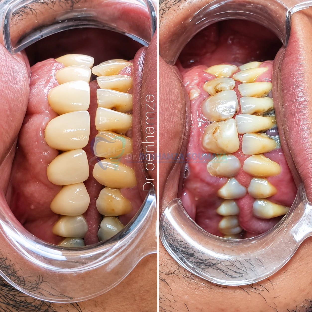 Prothèse fixe · cas clinique