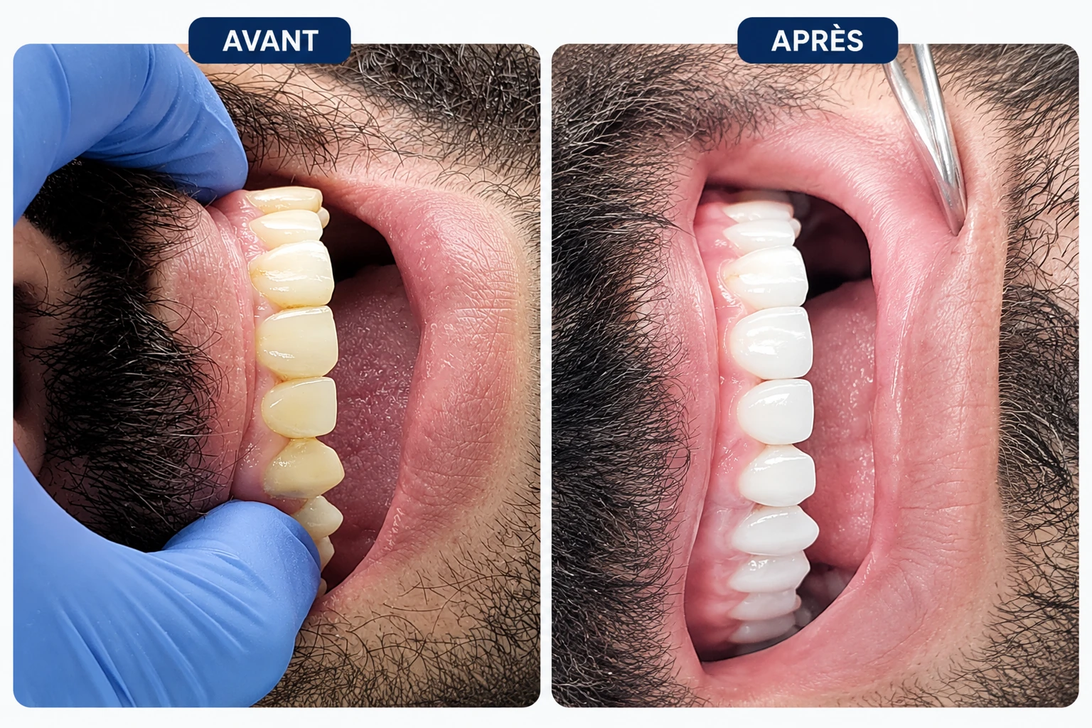 Facettes e.max alignement et teinte avant après, Smile's Centre El Jadida
